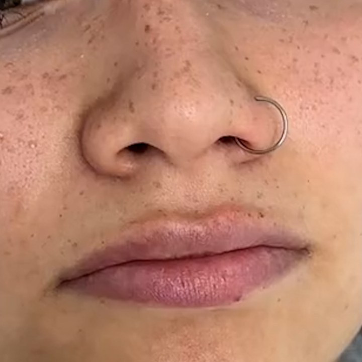 Antes - Preenchimento Labial - Est&eacute;tica Batel Curitiba