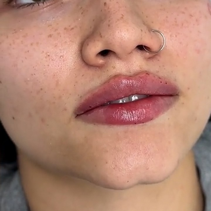 Depois - Preenchimento Labial - Est&eacute;tica Batel Curitiba