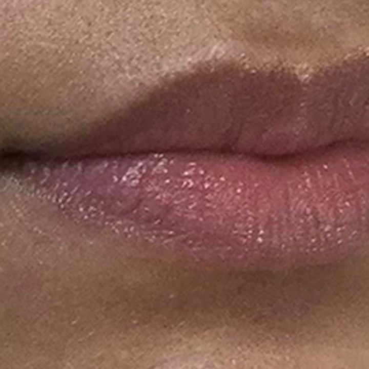 Antes - Preenchimento Labial - Est&eacute;tica Batel Curitiba