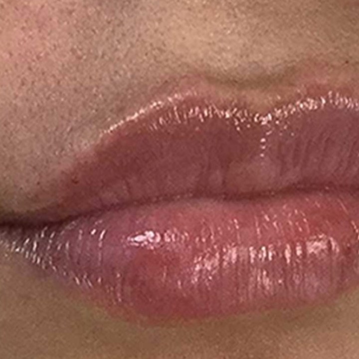 Depois - Preenchimento Labial - Est&eacute;tica Batel Curitiba