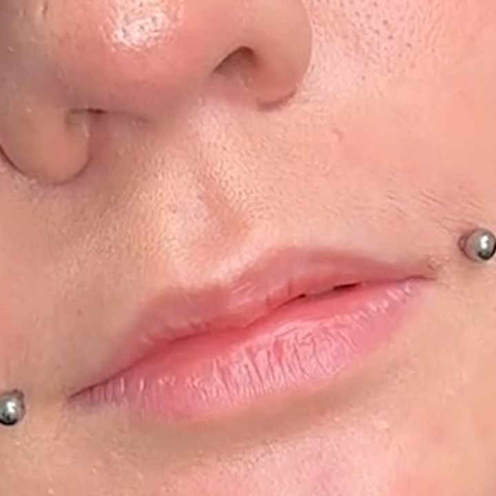 Antes - Caso 50 Preenchimento Labial