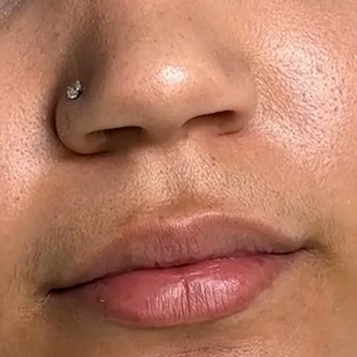 Antes - Caso 51 Preenchimento Labial