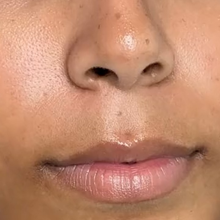 Antes - Preenchimento Labial - Est&eacute;tica Batel Curitiba