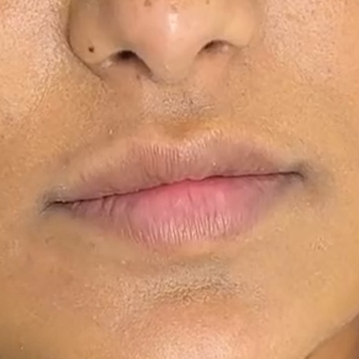 Antes - Preenchimento Labial - Est&eacute;tica Batel Curitiba