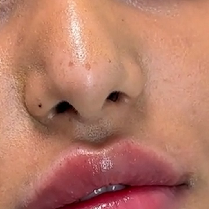 Depois - Preenchimento Labial - Est&eacute;tica Batel Curitiba