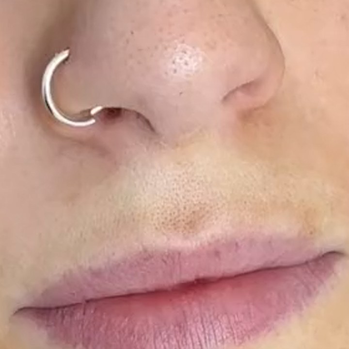 Antes - Preenchimento Labial - Est&eacute;tica Batel Curitiba