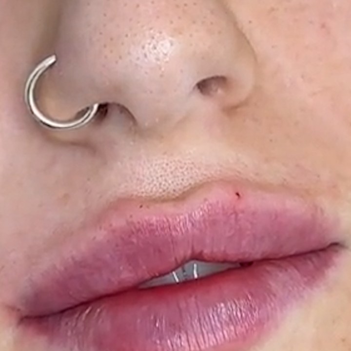 Depois - Preenchimento Labial - Est&eacute;tica Batel Curitiba