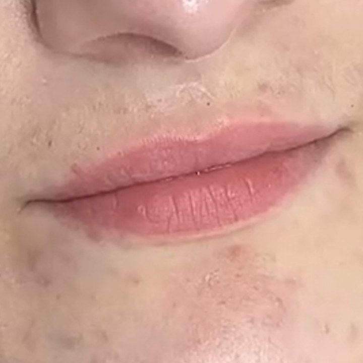 Antes - Preenchimento Labial - Est&eacute;tica Batel Curitiba