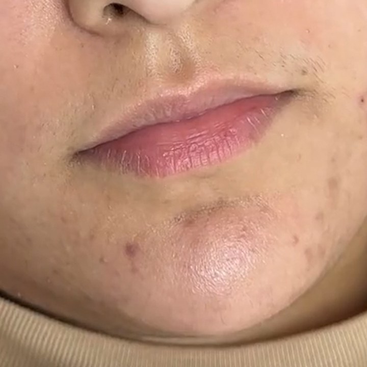 Antes - Preenchimento Labial - Est&eacute;tica Batel Curitiba