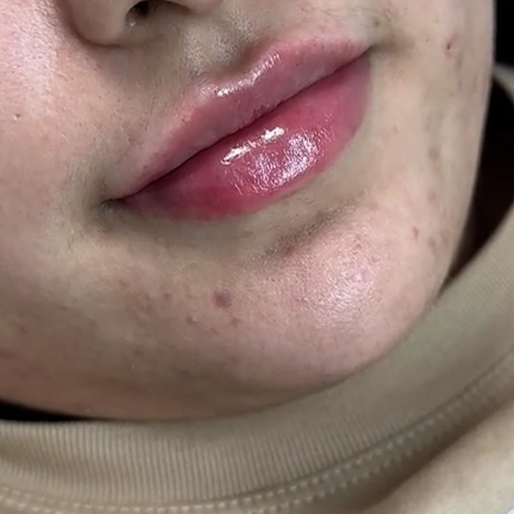 Depois - Preenchimento Labial - Est&eacute;tica Batel Curitiba