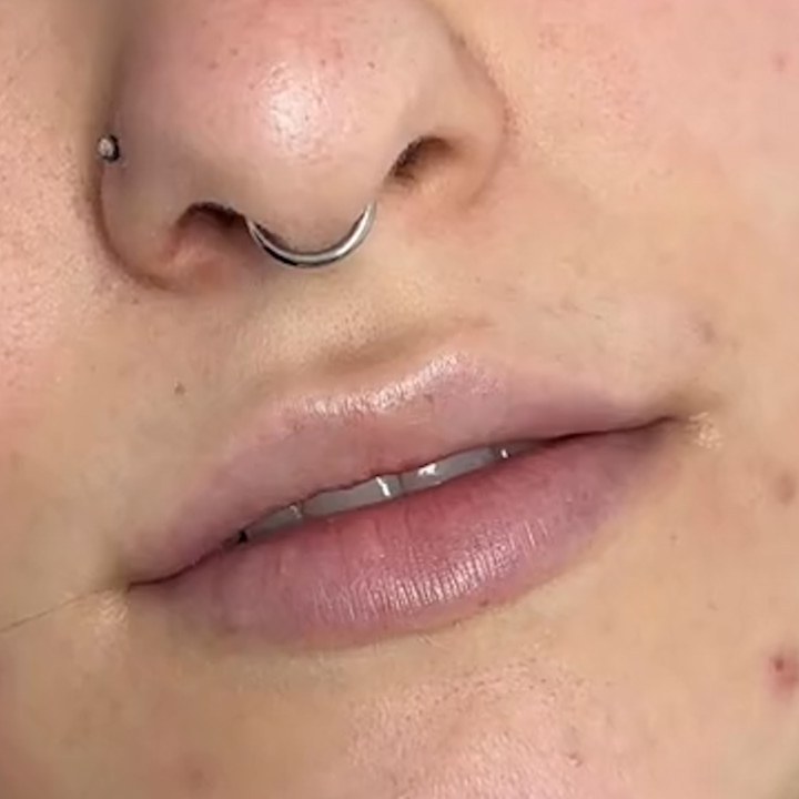 Antes - Preenchimento Labial - Est&eacute;tica Batel Curitiba