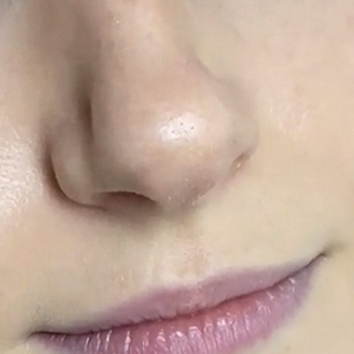 Antes - Preenchimento Labial - Est&eacute;tica Batel Curitiba