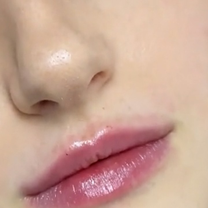 Depois - Preenchimento Labial - Est&eacute;tica Batel Curitiba