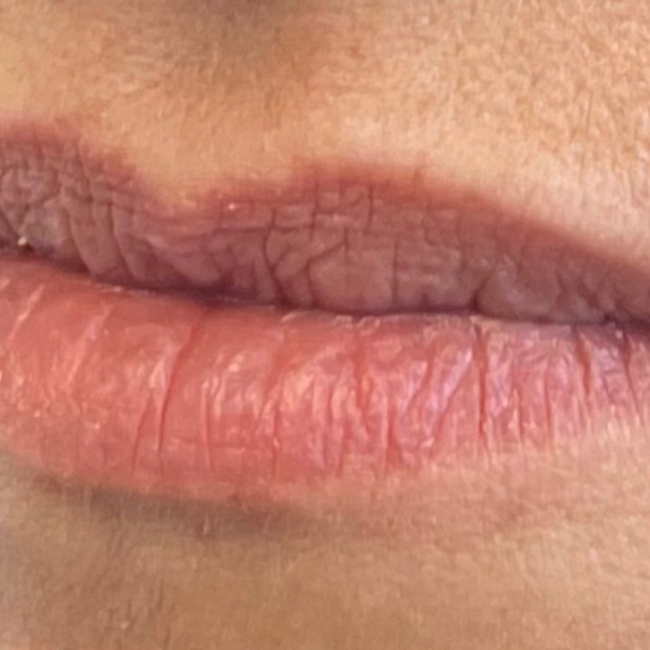 Antes - Caso 06 Preenchimento Labial