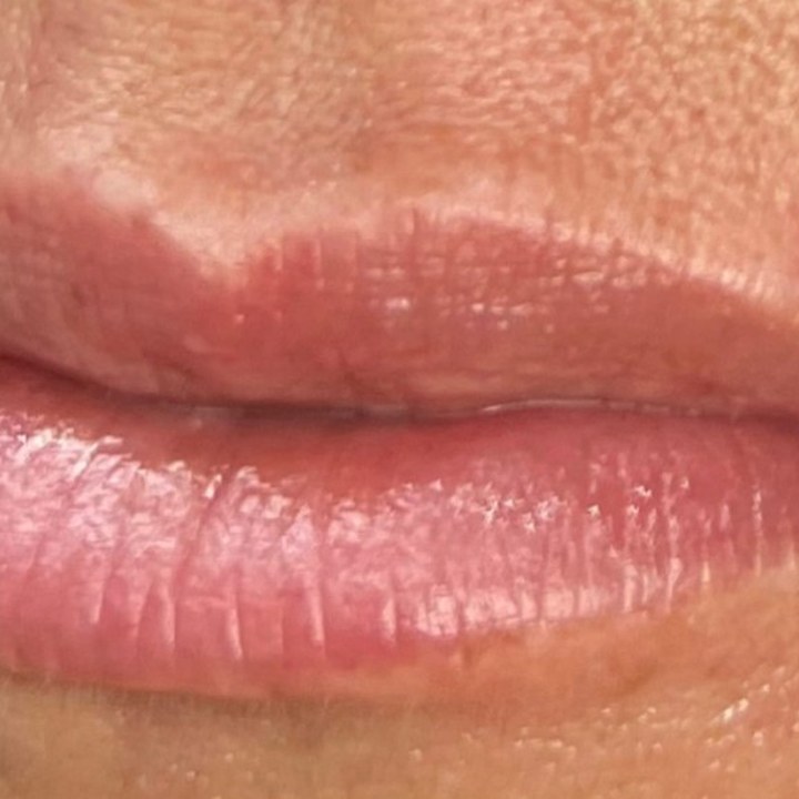Depois - Caso 06 Preenchimento Labial