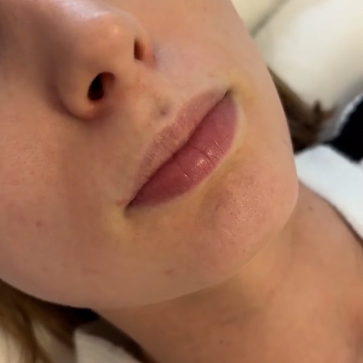 Antes - Preenchimento Labial - Est&eacute;tica Batel Curitiba