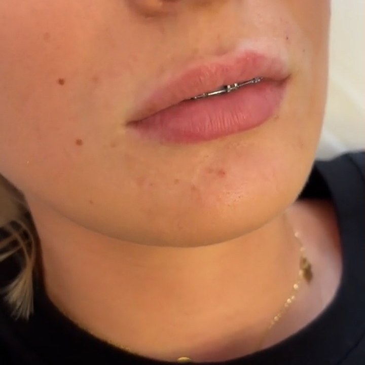 Antes - Caso 62 Preenchimento Labial