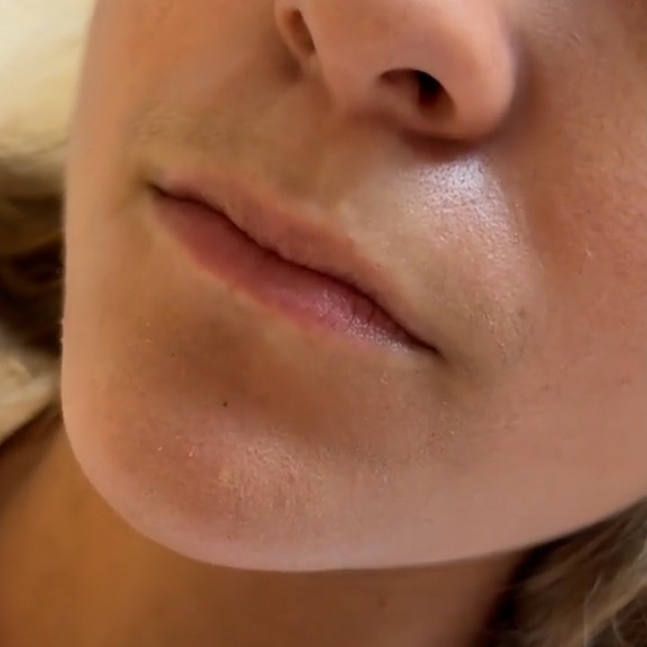 Antes - Preenchimento Labial - Est&eacute;tica Batel Curitiba