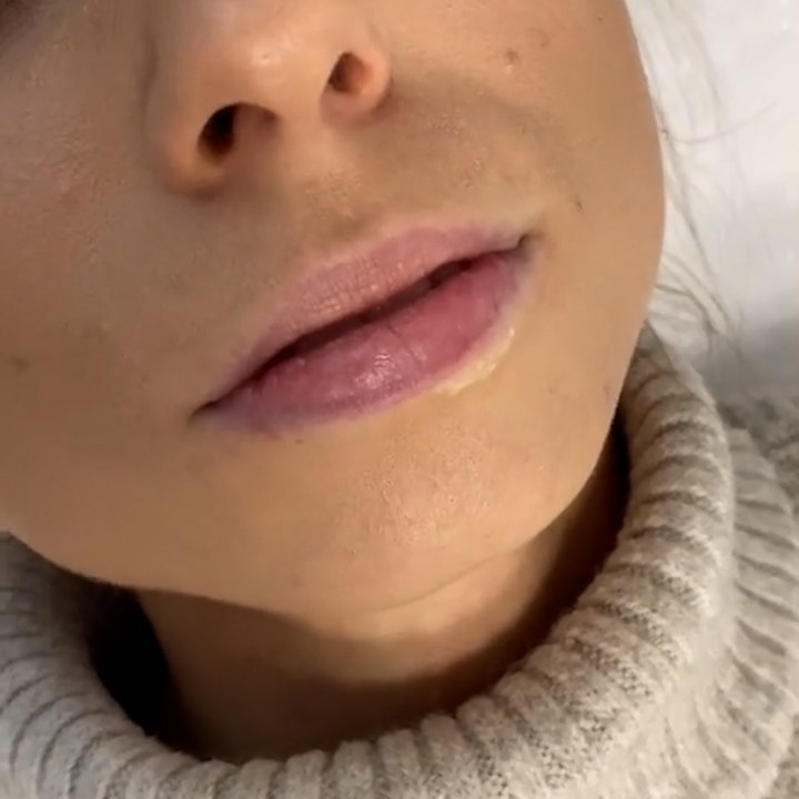 Antes - Caso 66 Preenchimento Labial