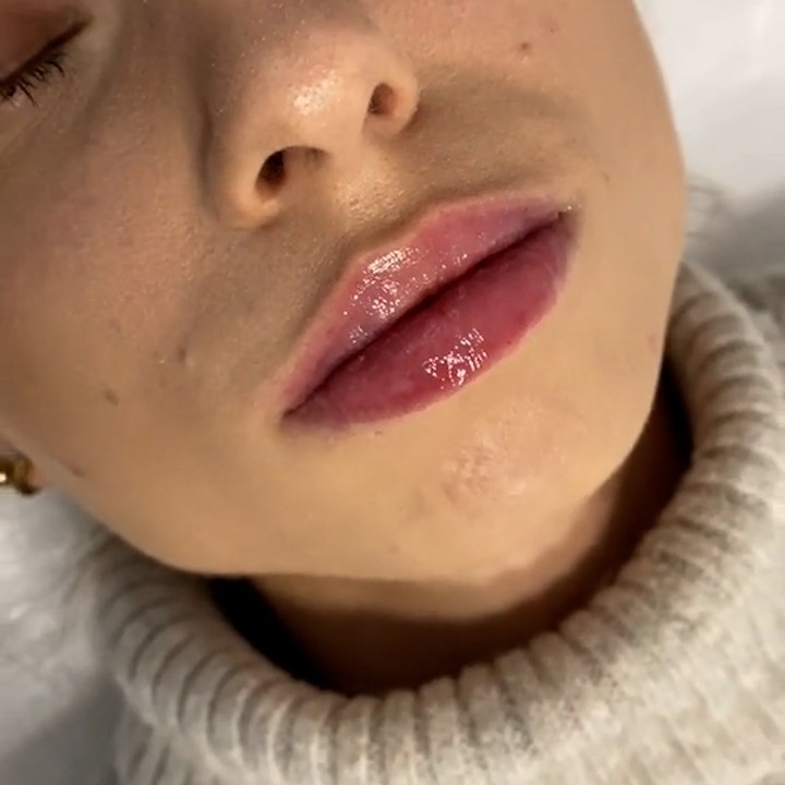 Depois - Caso 66 Preenchimento Labial