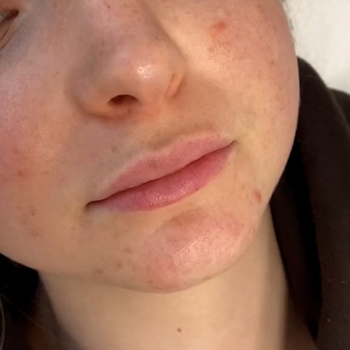 Antes - Preenchimento Labial - Est&eacute;tica Batel Curitiba