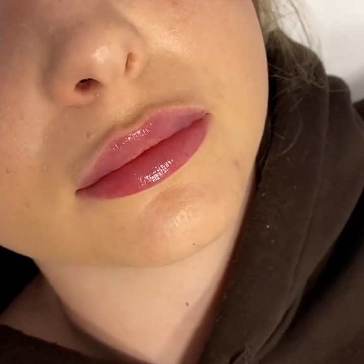 Depois - Preenchimento Labial - Est&eacute;tica Batel Curitiba