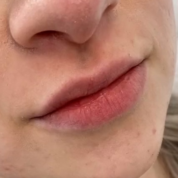 Antes - Preenchimento Labial - Est&eacute;tica Batel Curitiba