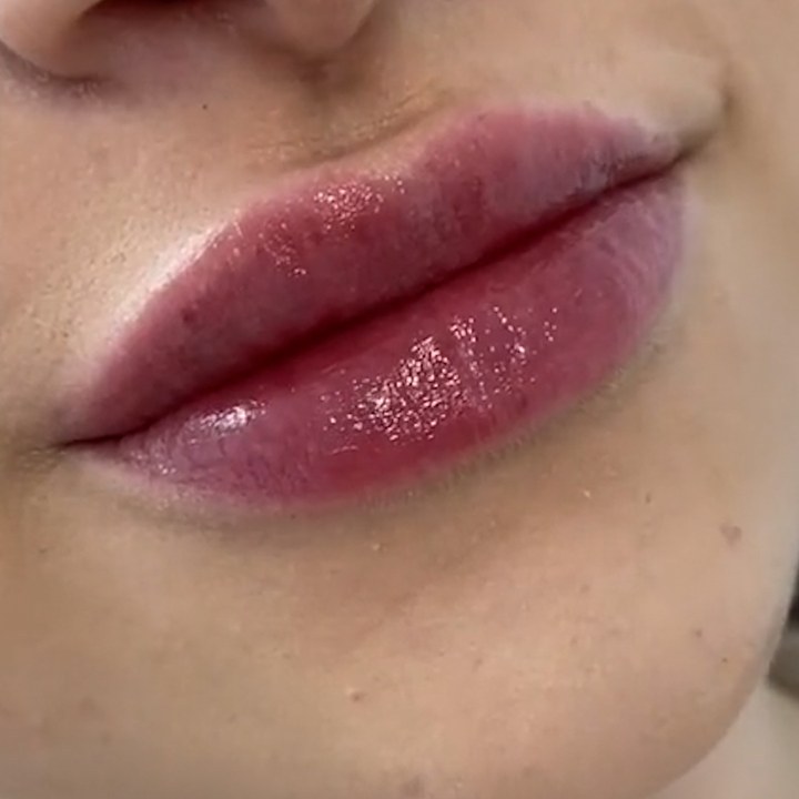 Depois - Preenchimento Labial - Est&eacute;tica Batel Curitiba