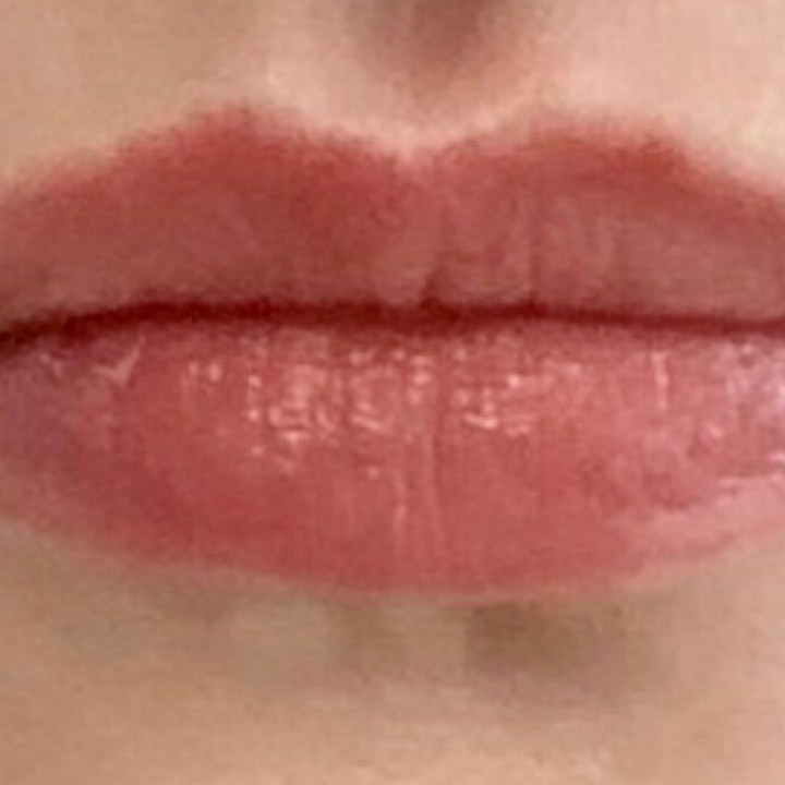 Antes - Caso 07 Preenchimento Labial