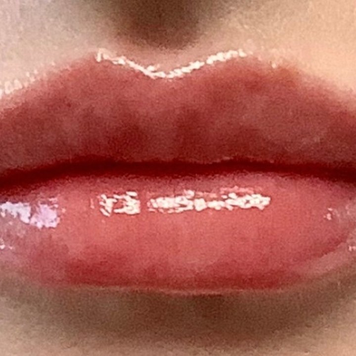 Depois - Caso 07 Preenchimento Labial
