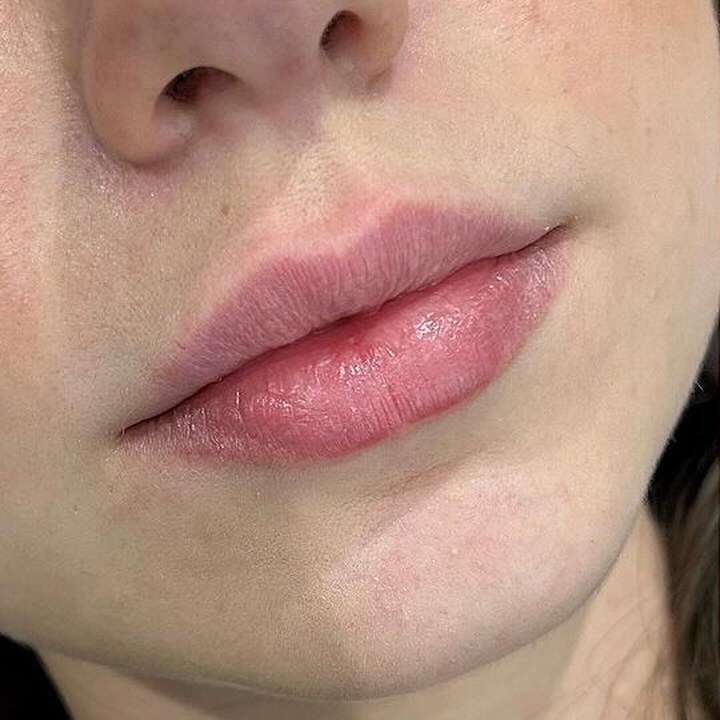 Antes - Caso 70 Preenchimento Labial