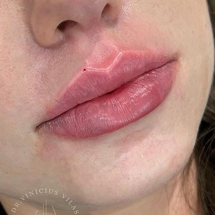 Depois - Caso 70 Preenchimento Labial