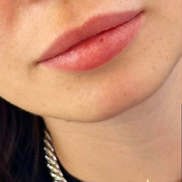 Antes - Preenchimento Labial - Est&eacute;tica Batel Curitiba