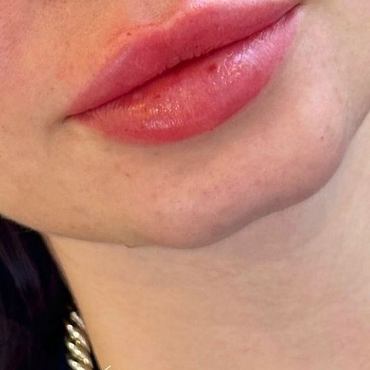 Depois - Preenchimento Labial - Est&eacute;tica Batel Curitiba