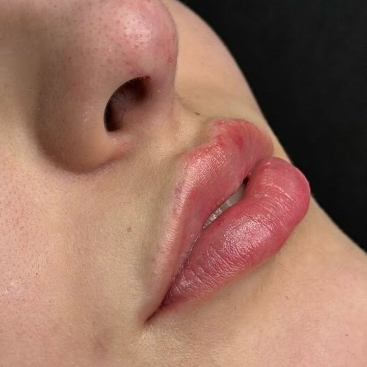 Antes - Preenchimento Labial - Est&eacute;tica Batel Curitiba