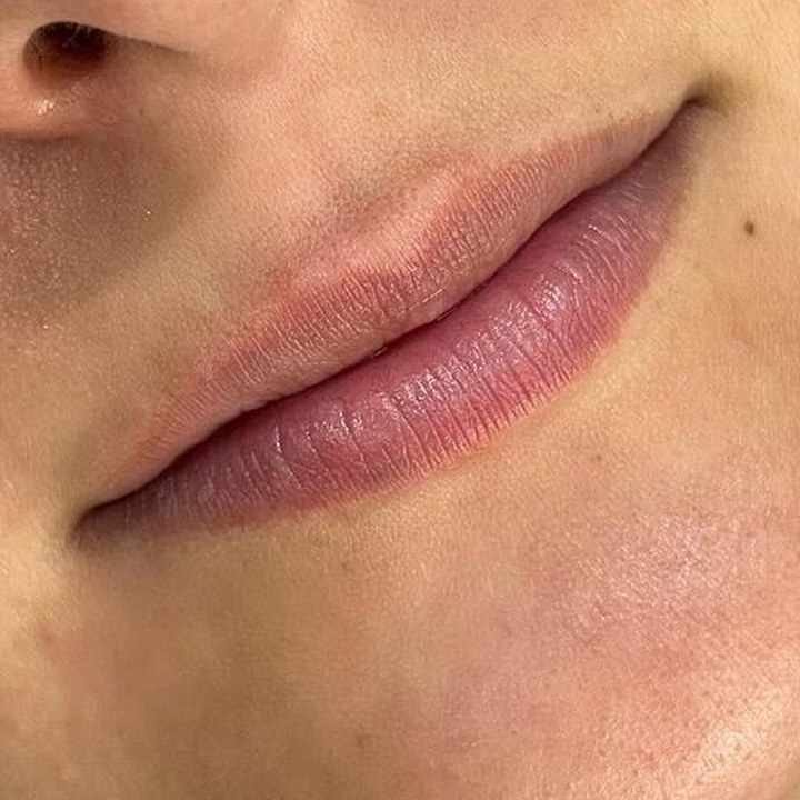 Antes - Caso 73 Preenchimento Labial
