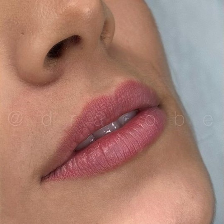 Antes - Caso 74 Preenchimento Labial