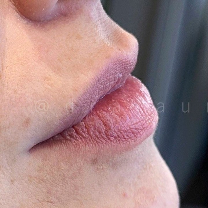 Antes - Preenchimento Labial - Est&eacute;tica Batel Curitiba