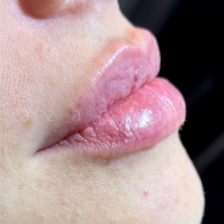 Depois - Preenchimento Labial - Est&eacute;tica Batel Curitiba