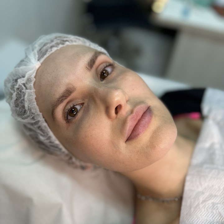 Antes - Preenchimento Labial - Est&eacute;tica Batel Curitiba
