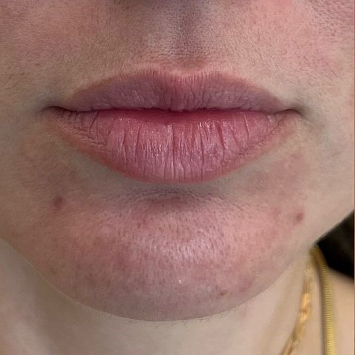 Antes - Preenchimento Labial - Est&eacute;tica Batel Curitiba