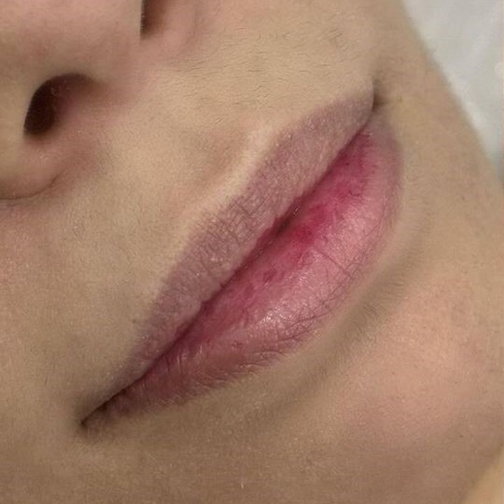Antes - Caso 78 Preenchimento Labial