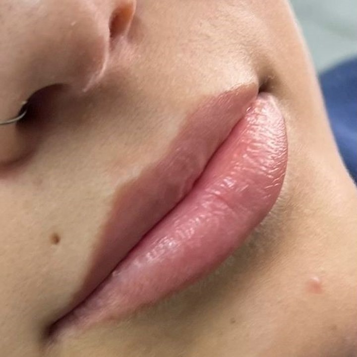 Antes - Preenchimento Labial - Est&eacute;tica Batel Curitiba