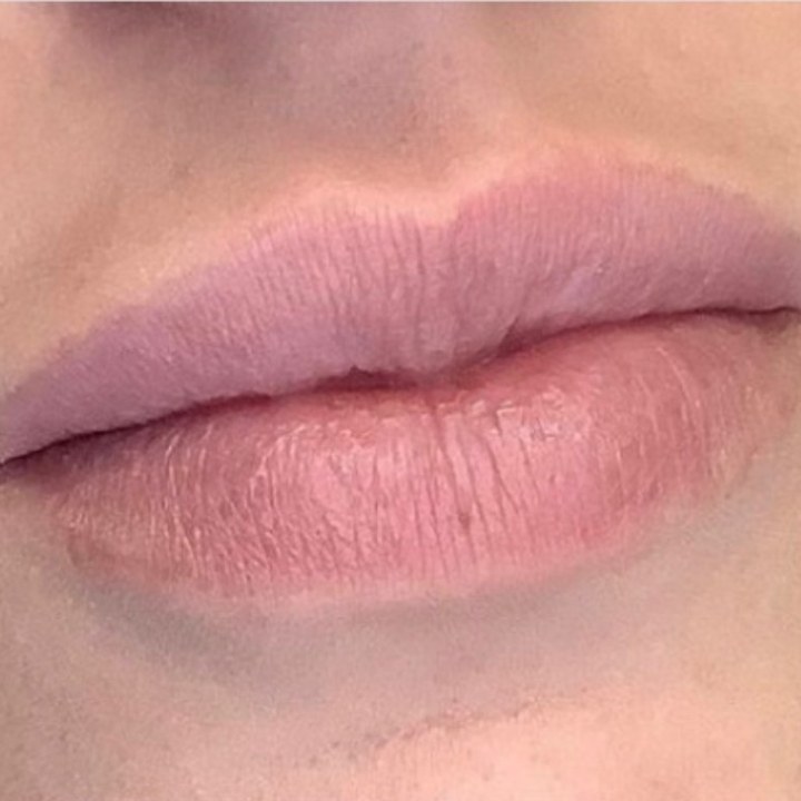 Antes - Preenchimento Labial - Est&eacute;tica Batel Curitiba