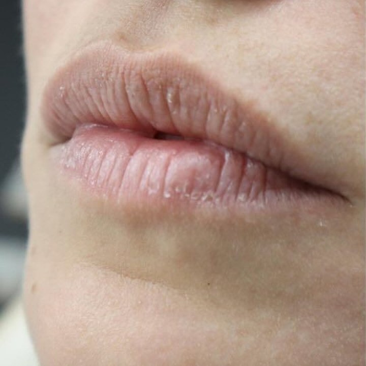 Antes - Preenchimento Labial - Est&eacute;tica Batel Curitiba