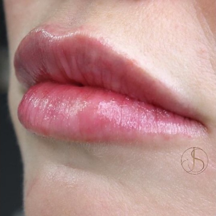 Depois - Preenchimento Labial - Est&eacute;tica Batel Curitiba