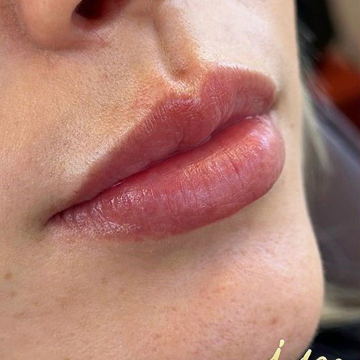 Antes - Preenchimento Labial - Est&eacute;tica Batel Curitiba
