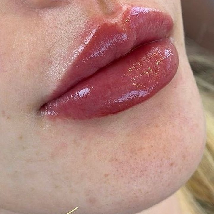 Depois - Preenchimento Labial - Est&eacute;tica Batel Curitiba