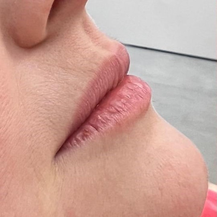 Antes - Preenchimento Labial - Est&eacute;tica Batel Curitiba