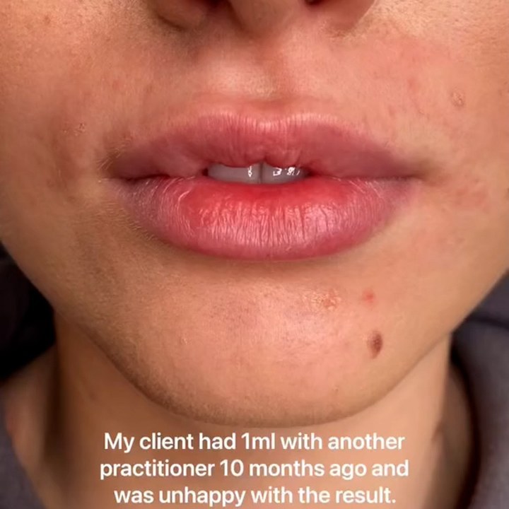 Antes - Caso 83 Preenchimento Labial